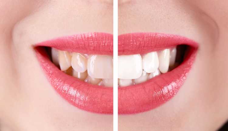 اصفرار الأسنان الاستفادة من تأثير لصقات الأسنان