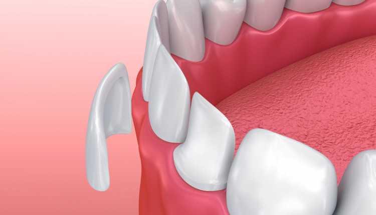 اصفرار الأسنان تركيب الأسنان الخزفية أو أسنان البورسلين