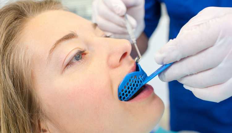 اصفرار الأسنان علاج اصفرار الأسنان بواسطة القوالب المبيضة