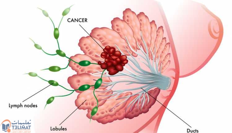 سرطان الثدي سرطان الثدي الالتهابي