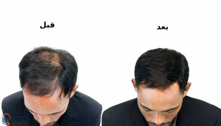 بعد زراعة الشعر ماذا يحدث بعد زراعة الشعر بشهرين؟