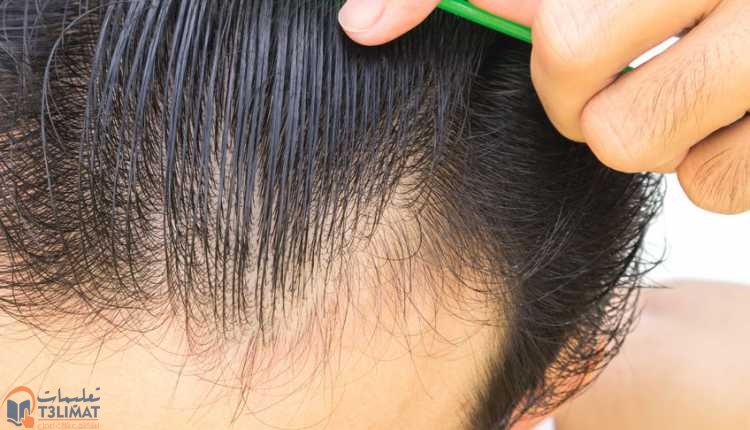 بعد زراعة الشعر سعر وأماكن إجراء عملية زراعة الشعر في الدول العربية